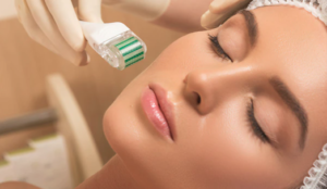 microneedling